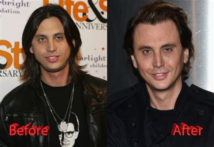 Has Jonathan Cheban Had Plastic Surgery?