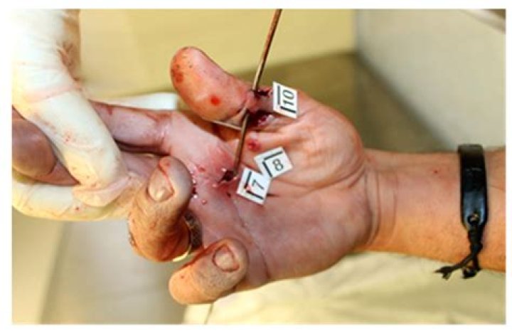 
What has Happend to Gabriel Hojnacki? Gabriel Hojnacki died from a gunshot accident 