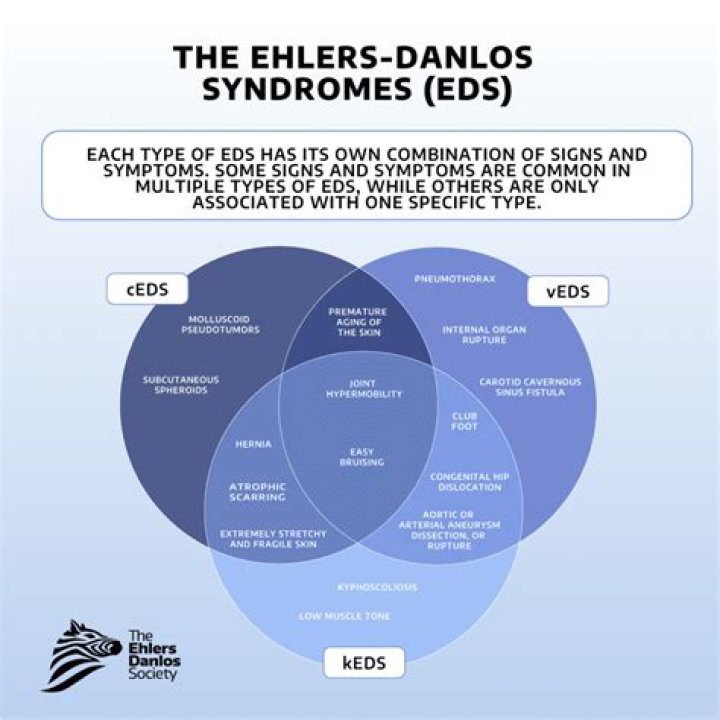 
Yvie Oddly Has Ehlers–Danlos Syndrome Type 3: More On The Drag Queen Illness And Health Update 2022 